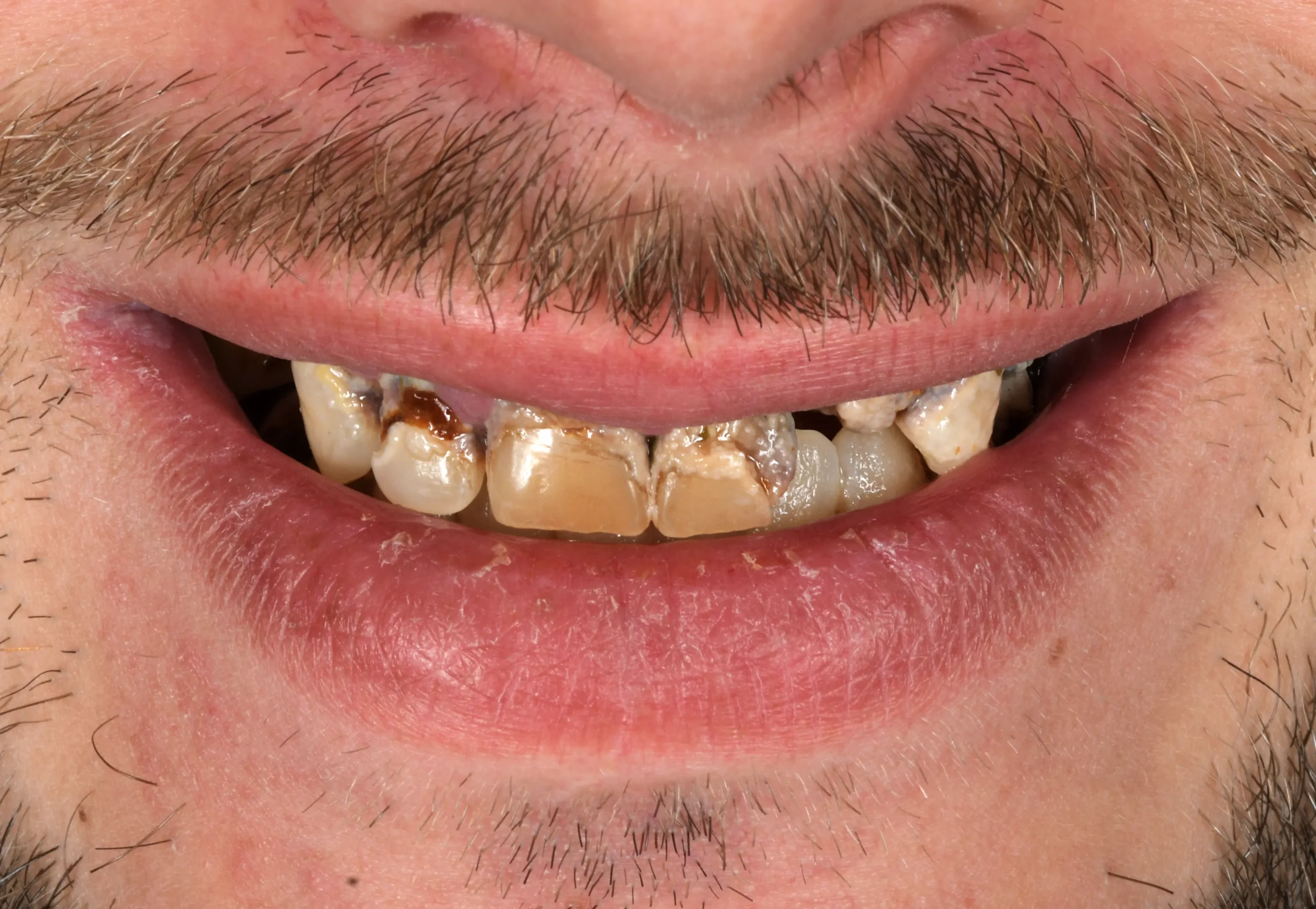 All On 6 Treatment — Before