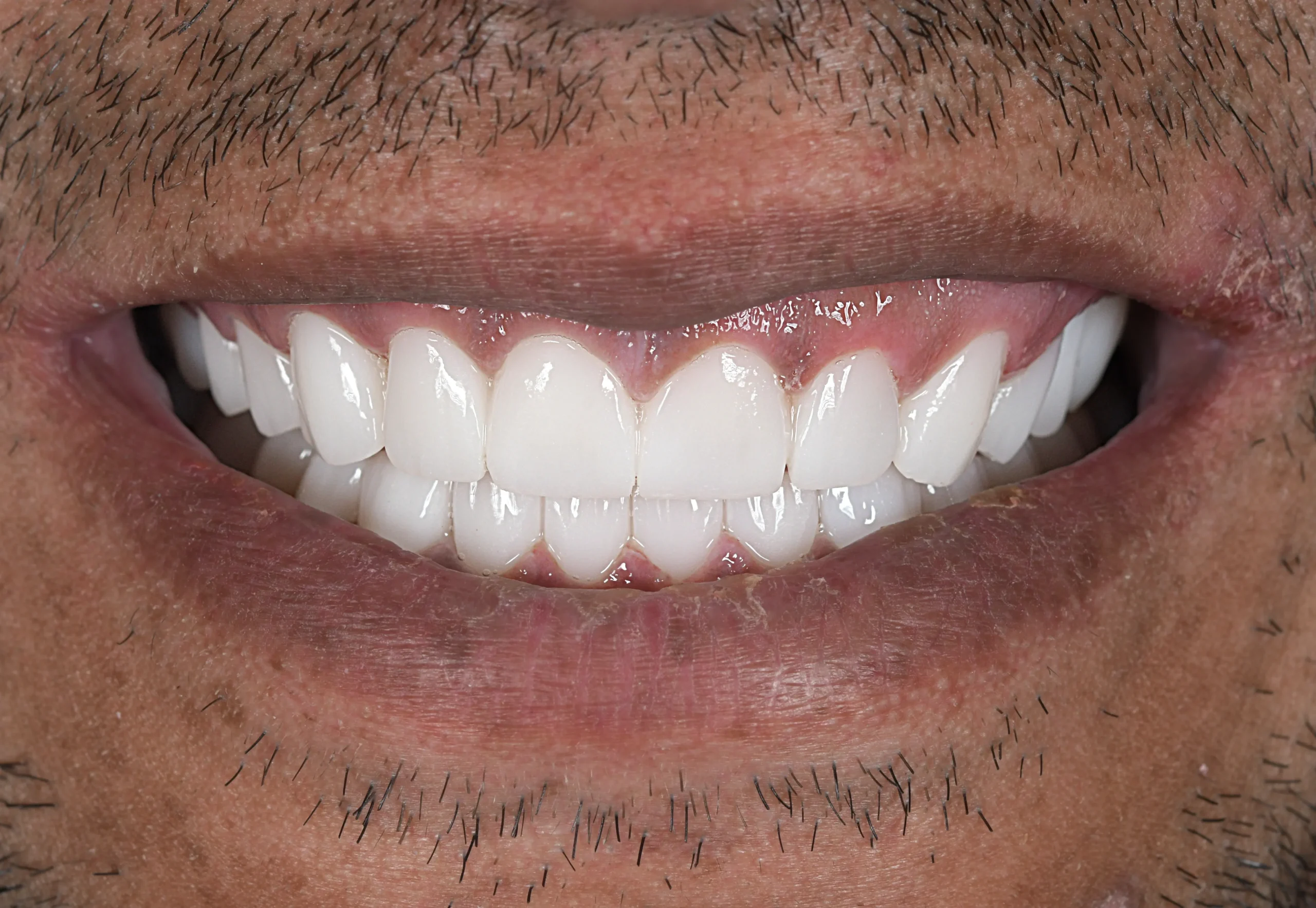 Hollywood Smile Makeover — After